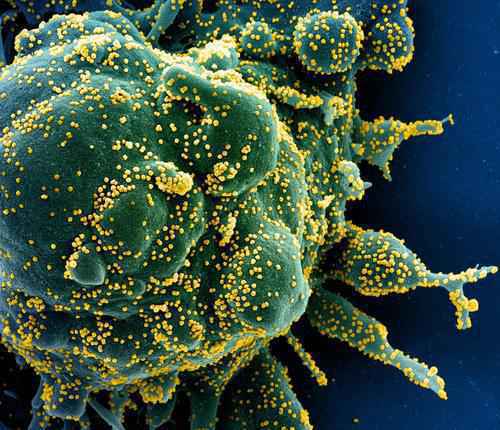 首张新冠病毒感染人肺细胞分子反应图绘出|国际战“疫”行动